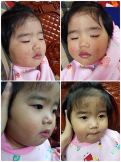 Kem nẻ viện bỏng vaselin