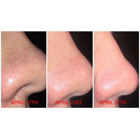 Dung Dịch Đặc ngừa Mụn Ẩn Paula's Choice Skin Perfecting 2% BHA Liquid (MiniSize 30ml)