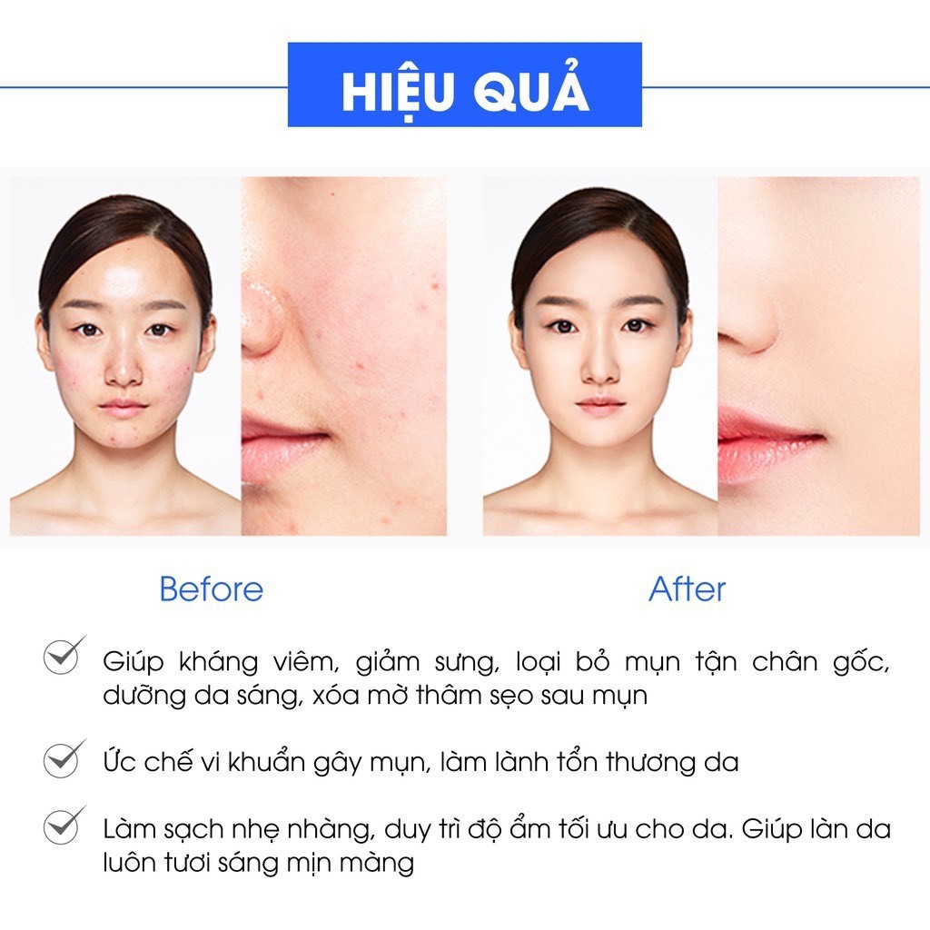 (Chính Hãng 100%) Kem Ngừa Mụn Siêu Tốc Độ Acosmetics, Gồm serum chấm mụn và Kem dưỡng ngừa thâm