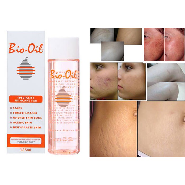 Tinh Dầu Bio Oil Làm Mờ Sẹo, Rạn Da, Thâm Nám | BigBuy360 - bigbuy360.vn