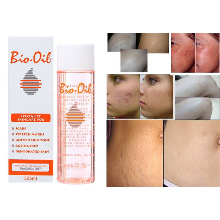 Tinh Dầu Bio Oil Làm Mờ Sẹo, Rạn Da, Thâm Nám