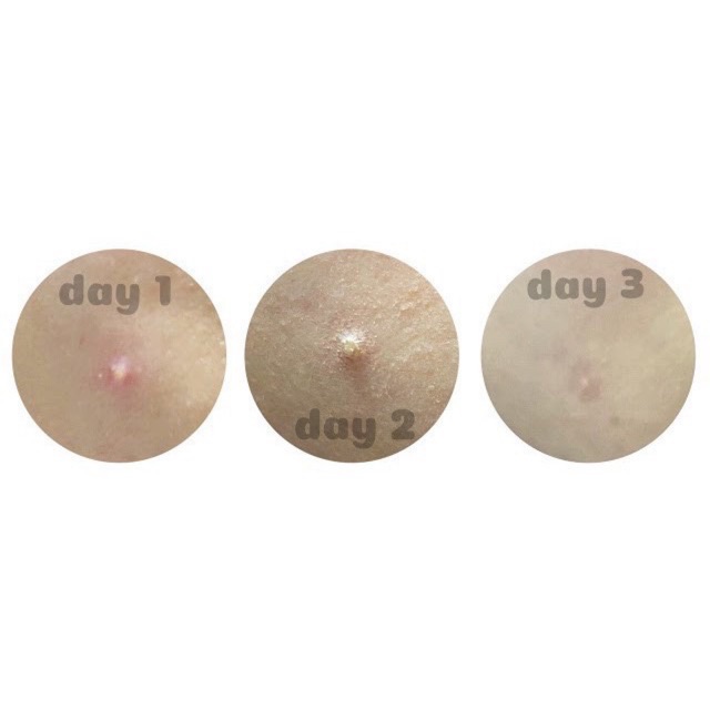 [15/60] Benzac AC 2,5% , 5% - Kem hỗ trợ giảm mụn | BigBuy360 - bigbuy360.vn