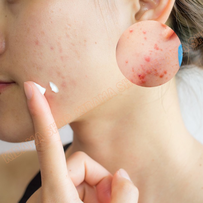 Gel MỤN Derma Forte giúp ngăn ngừa và giảm loại mụn trứng cá, mụn đầu đen, mụn đầu trắng mờ thâm liền sẹo | BigBuy360 - bigbuy360.vn