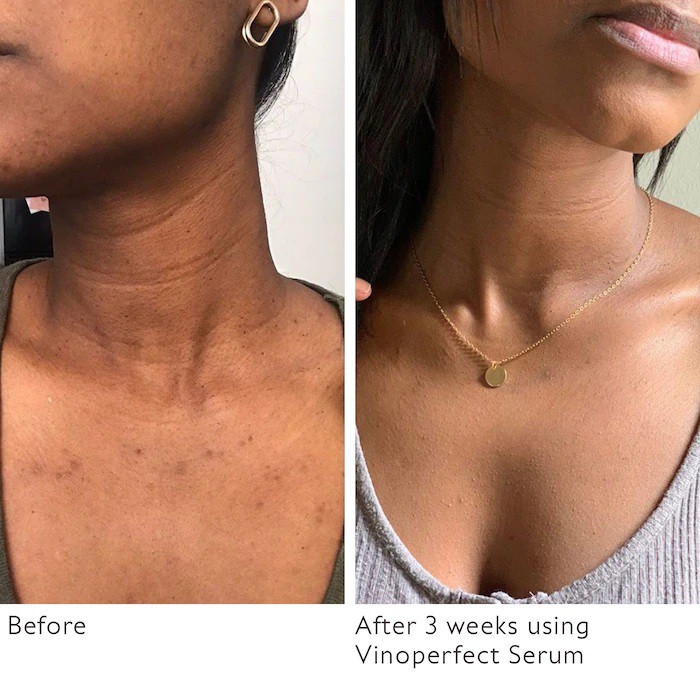 CAUDALIE 🌿 Tinh chất sáng da giảm thâm nám Vinoperfect Radiance Serum Complexion Correcting