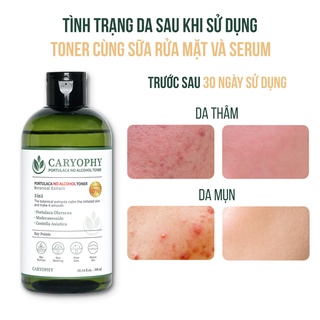 Combo chăm sóc da mụn Caryophy Portulaca (sữa rửa mặt 150ml toner 300ml serum 10ml)