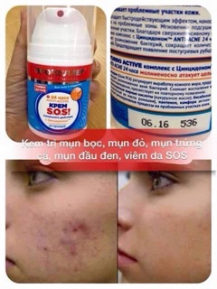 Kem trị mụn khẩn cấp SOS turbo active Nga