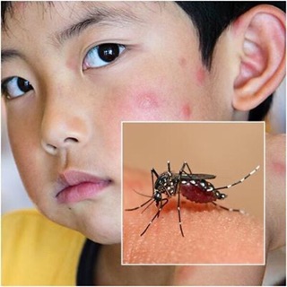 Kẹp chống côn trùng cho bé