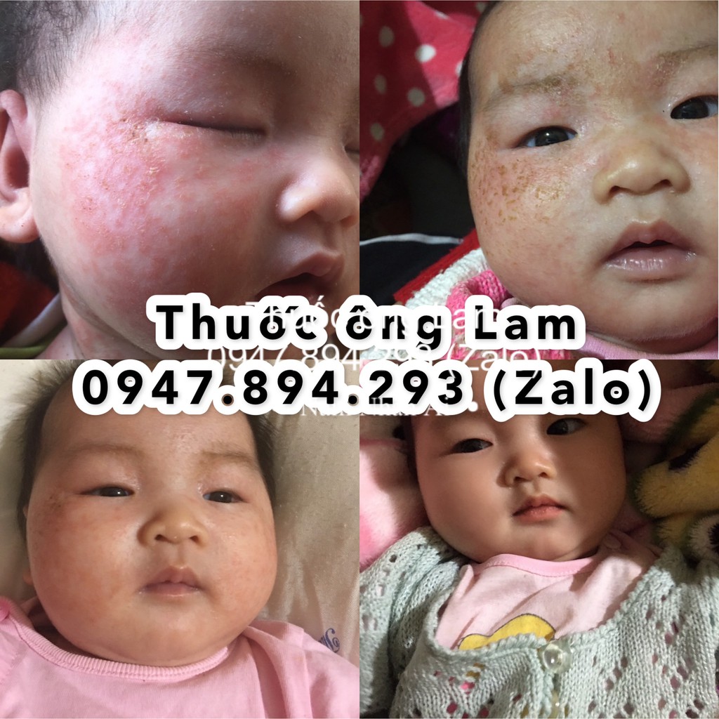 Tổ đỉa, chàm, chàm sữa, mẩn ngứa, cơ địa Ông Lam | BigBuy360 - bigbuy360.vn