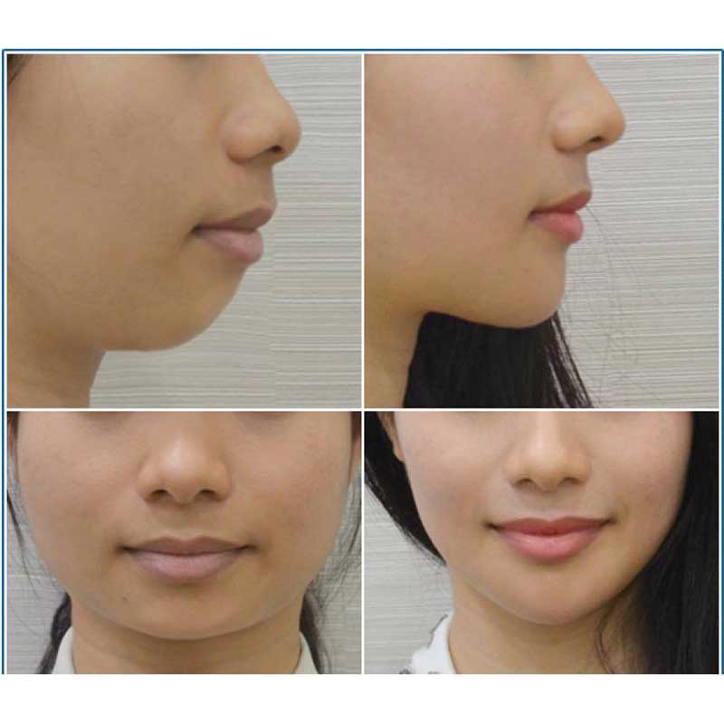 Kem Nâng Cơ Chống Chảy Xệ, Loại Bỏ Vùng Mỡ Thừa Ở Cằm, Cổ Novosvit Kpem 50ml Nga