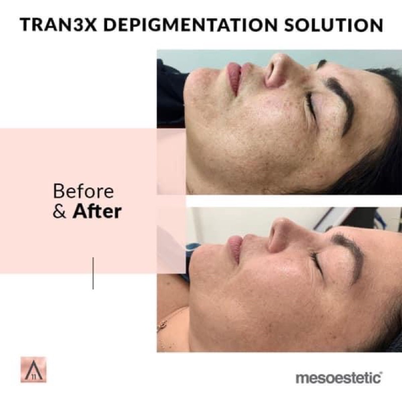 ✅Chính Hãng có tem ✅ Serum giảm nám chuyên sâu Mesoestetic Melan Tran3x Concentrate 30ml