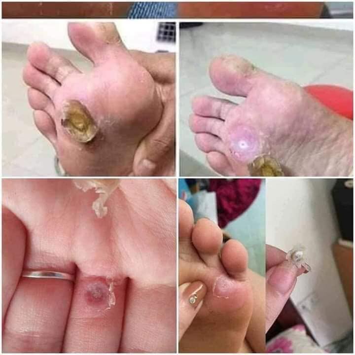 Dung dịch diệt mụn cơm, mụn cóc, sạn cá, mụn thịt của nga, sẵn hàng | BigBuy360 - bigbuy360.vn