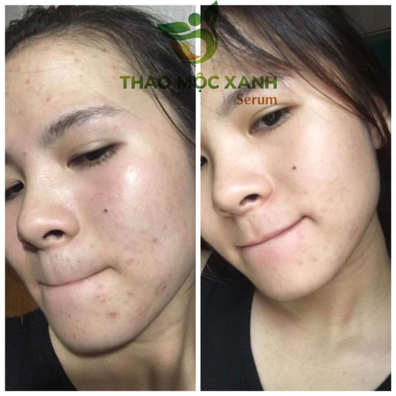 [ CHÍNH HÃNG]SERUM THẢO MỘC XANH | BigBuy360 - bigbuy360.vn