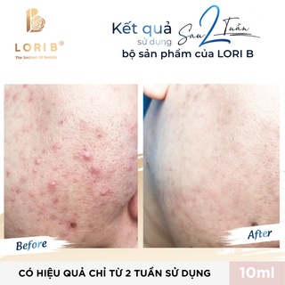 Combo Kem mụn, Sữa rửa mặt Lori B