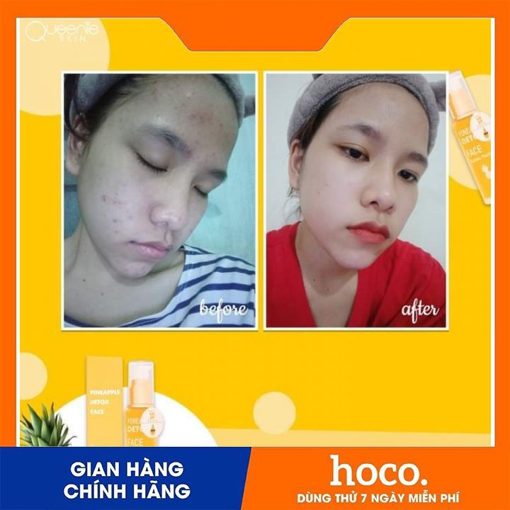 Detox Thảy Độc (Trắng Da ) Queenie Skin