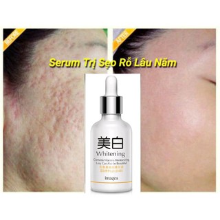 SERUM SẸO RỖ SẸO MỤN LÂU NĂM chính hãng