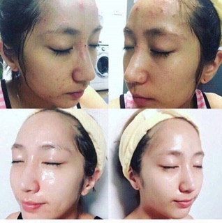 Peel da căng bóng The Ordinary AHA 30% + BHA 2% Peeling Solution