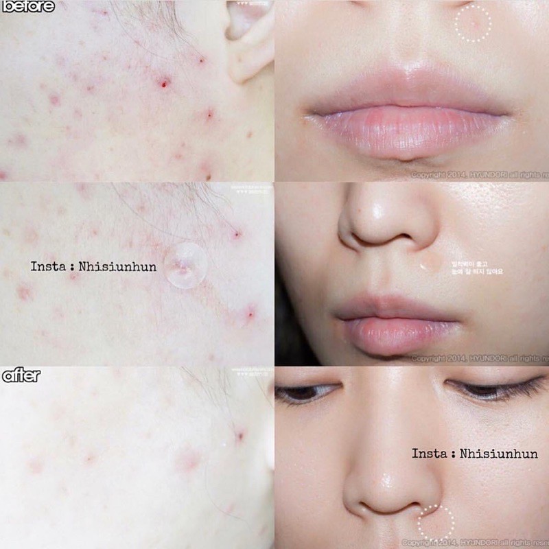 Miếng dán hút mụn Cosrx Acne Pimple Master Patch Cosrx