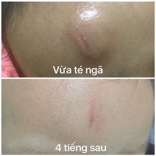 Kem giữ ấm cho bé - Làm tan vết côn trùng cắn - Làm tan vết sưng trên mặt cho trẻ - TEPP CARE- tube 50ML