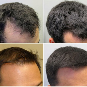 Minoxidil 5% Kirkland chính hãng - Tiết kiệm hơn với Hộp lớn dùng trong 6 Tháng