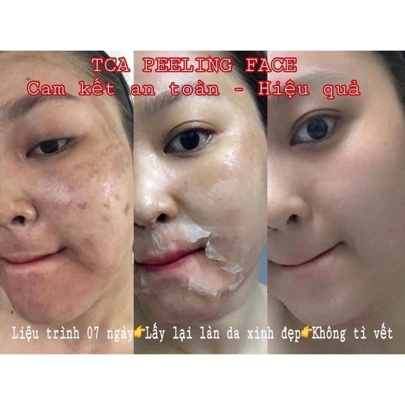 TCA 50% Sạch mụn, Hết rỗ, thâm, nám, lỗ chân lông to, da dầu, rạn, Làm Hồng Ti, peel Nách, bẹn, mông