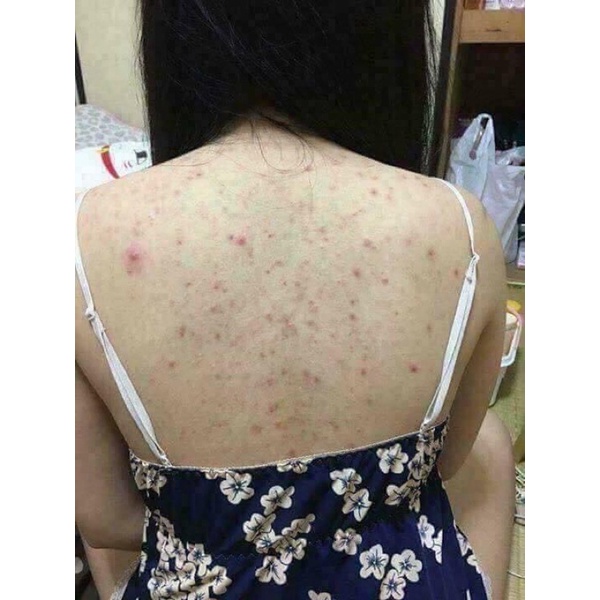 Xịt mụn toàn thân Thái Lan Vitara SE BODY ACNE SPRAY giảm thâm mụn, sẹo mụn 50ml