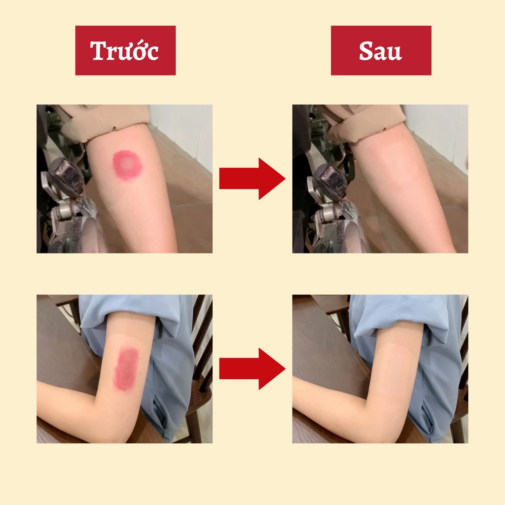 Miếng dán che sẹo tuyến giáp, sẹo sau sinh Nhật Bản từ slicon siêu mỏng, chống nước