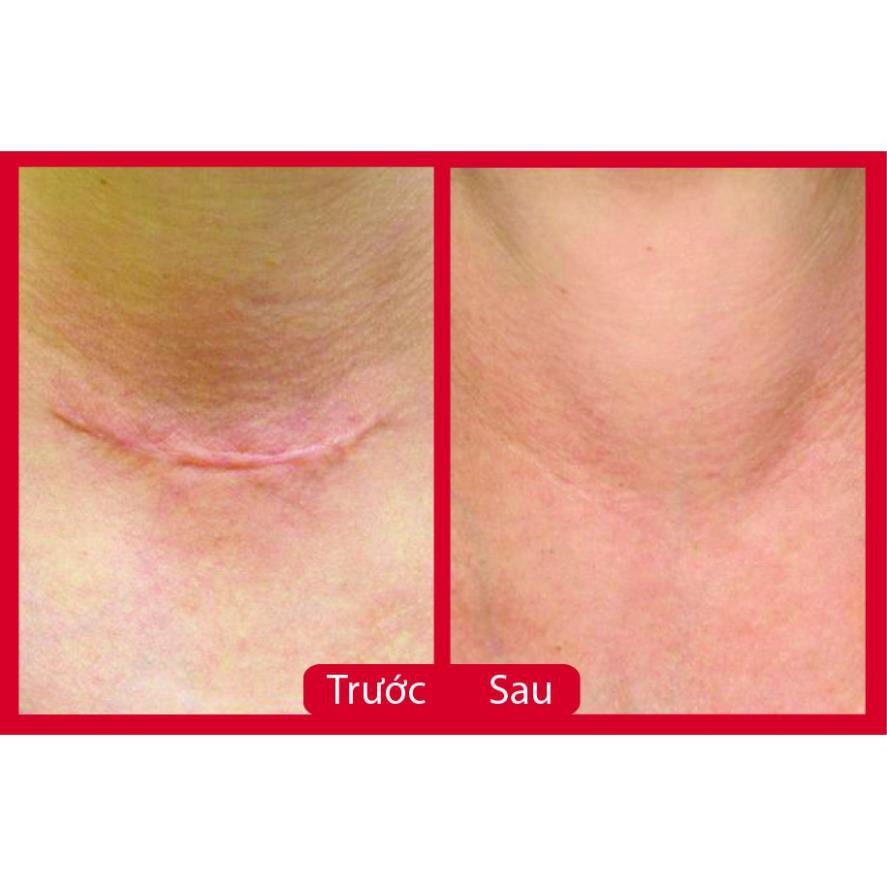 Serum Sẹo Lồi - Sẹo Lõm - Sẹo Rỗ Lâu Năm V3 | BigBuy360 - bigbuy360.vn