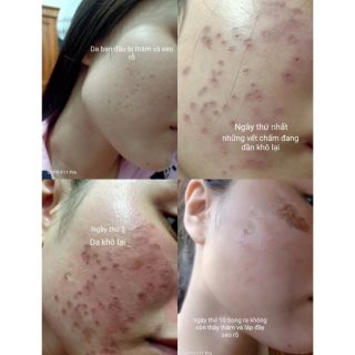 SÉT NHỎ PEEL TCA USA