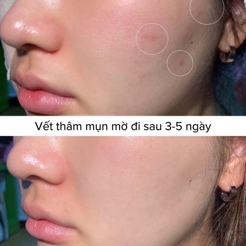 Tinh chất và kem dưỡng vitamin C 25% lumiderm trắng da xoá thâm nám