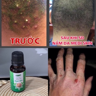 Nấm Da Medi-Skin