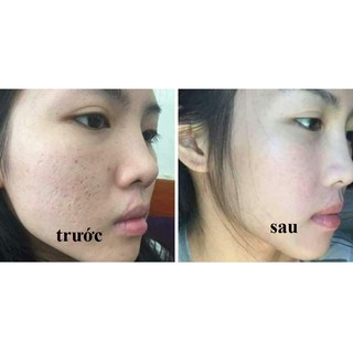 KEM TRỊ SẸO LOSHALL SCARS REMOVE
