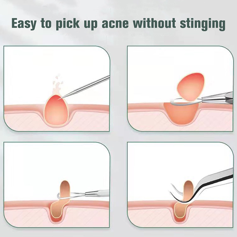 Nhíp Gắp Mụn Đầu Đen Bằng Thép Không Gỉ Siêu Mịn Chuyên Dụng Cho Salon Làm Đẹp
