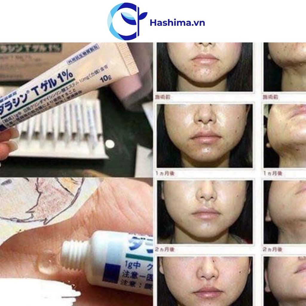 Gentacin - Kem sẹo Gentacin Nhật Bản - Giảm thiểu việc hình thành sẹo và mụn | BigBuy360 - bigbuy360.vn