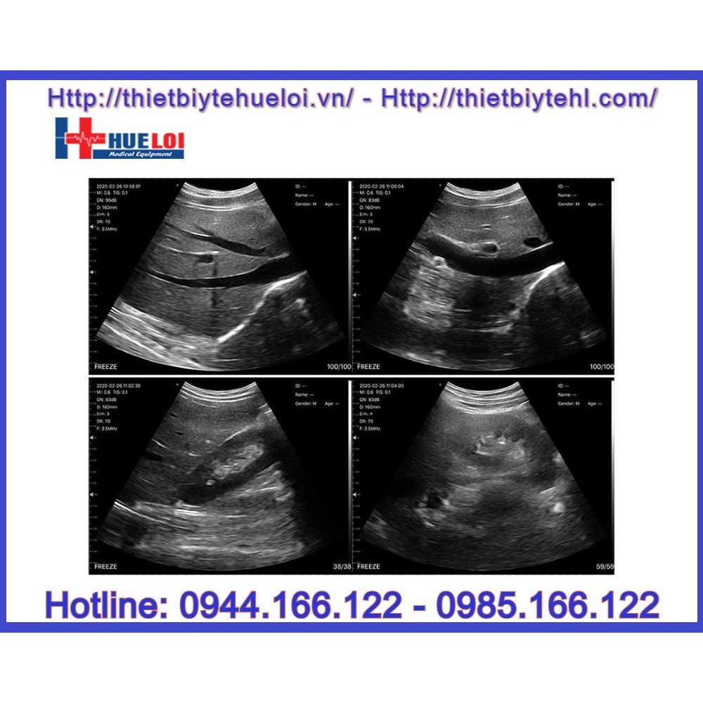 Đầu dò siêu âm Convex kết nối điện thoại không dây _ Thiết bị y tế Huê Lợi