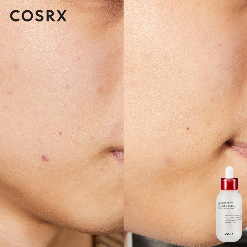 Tinh chất serum dưỡng làm mờ vết thâm COSRX AC Collection Blemish Spot Clearing Serum 40ml