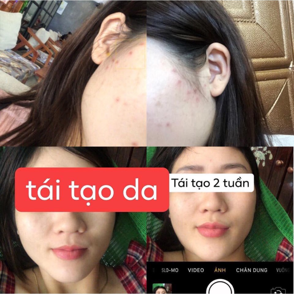 Tai tao 2 lọ 50ml sạch mụn thâm rỗ không tái lại