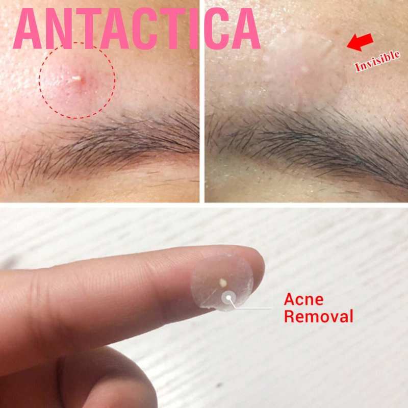 Set 36 Miếng Dán Che Mụn Chống Thấm Nước Thoáng Khí | BigBuy360 - bigbuy360.vn