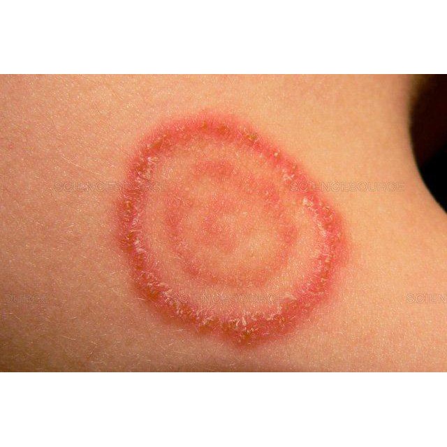 ✅ Kem bôi nấm ngứa, tổ đỉa, hắc lào, lang ben, vảy nến, á sừng,viem da các vấn đề da liễu lâu năm | BigBuy360 - bigbuy360.vn