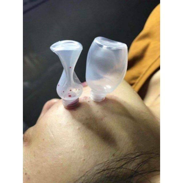 ống hút máu bầm
