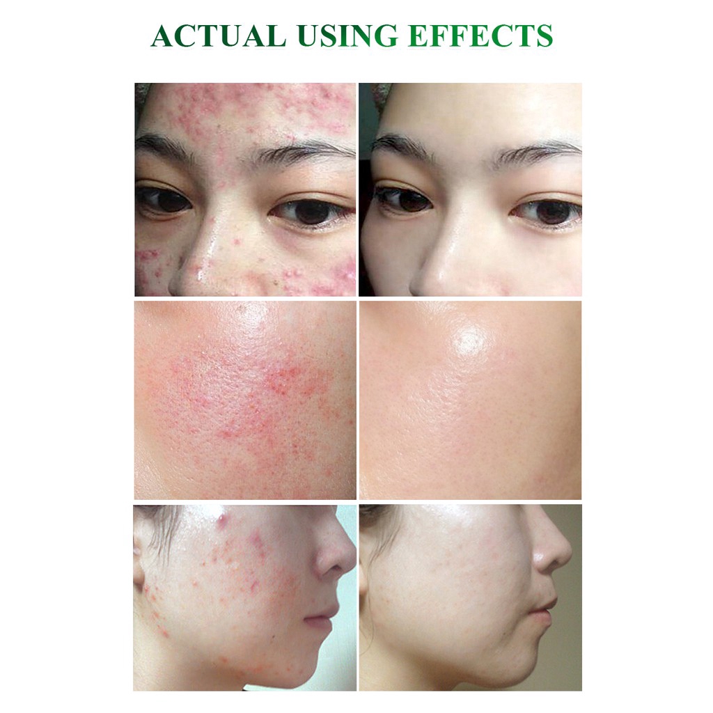 Serum hỗ trợ giảm Mụn BREYLEE 17ML+Kem hỗ trợ giảm Mụn Breylee 20g
