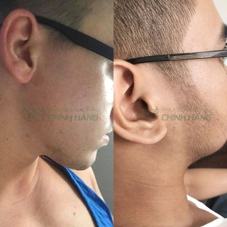 Dung dịch mọc râu tóc Minoxidil Combo 3 lọ lỏng