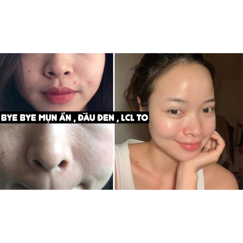 Megaduo Gel Aha &amp; Megaduo Plus Retinal 1.0 Giảm Thâm Mụn/trứng Cá/mờ Sẹo/ Vitamin C E Dưỡng Da Gel MS C 15g - Balan Shop