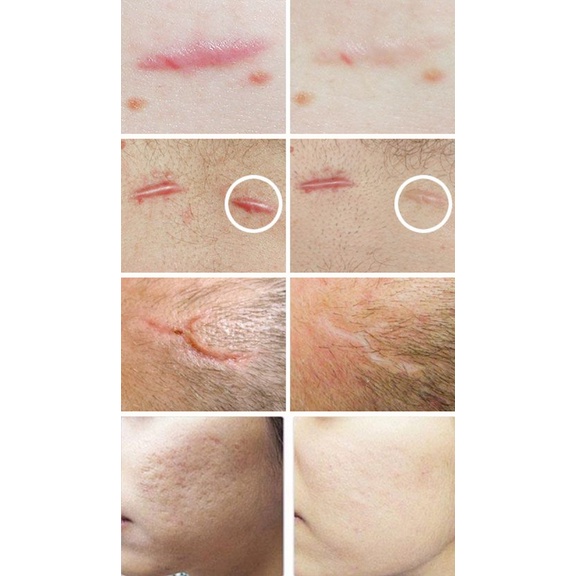 Gel Hỗ Trợ Làm Mờ Sẹo Strataderm 10g - Chính Hãng Thụy Sĩ