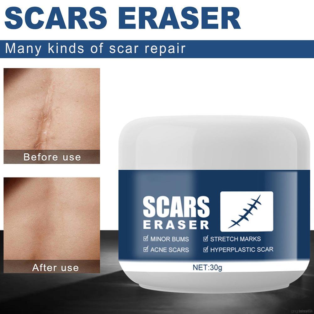 Multi-effect Scar Acne Cream Pimple Treatment Cream Scar Removal Cream- Stretch Marks Remover Cream For All Skin Types, New And