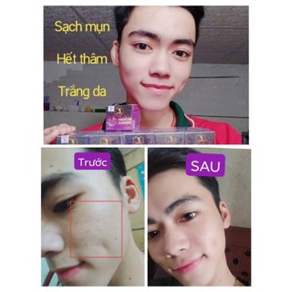 combo 5 hộp face mụn( mua 10hộp tặng 1 hộp)