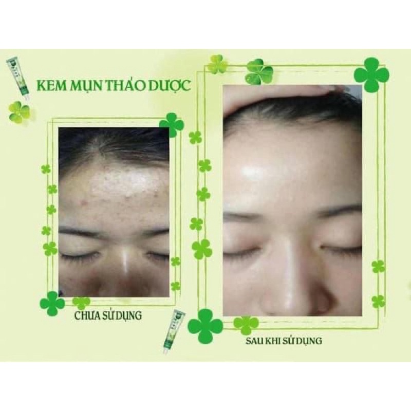 Kem trị_mụn sinori