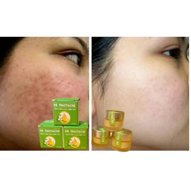 Kem cho da mụn Skinacne - Chiết suất rau má Diếp cá