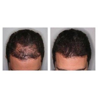 Serum MỌC RÂU-MỌC TÓC- MỌC LÔNG MÀY BEARD OIL-UAE