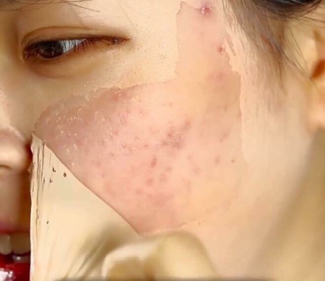 Gel "vá da" che khuyết điểm Real Skin Patch 