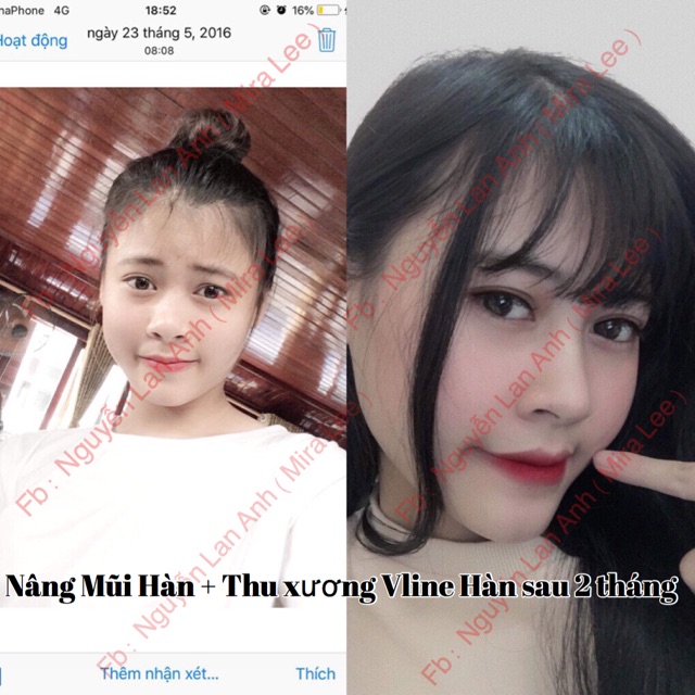 Serum Nâng Cao Mũi Hàn